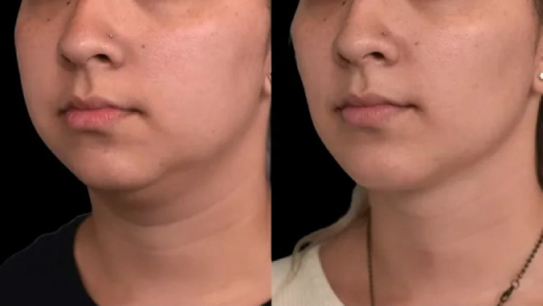 What Happens If You Gain Weight After Double chin removal Surgery in dubai?