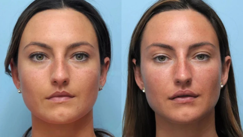 Who Can Benefit from Thread Lift Treatments in Dubai
