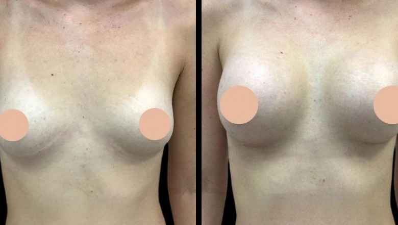 Breast Augmentation in Dubai: Combining Procedure with Other Cosmetic Enhancements