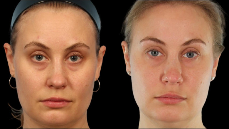 Personalized Under Eye Fillers Experiences at the Best Aesthetic Clinics in Dubai