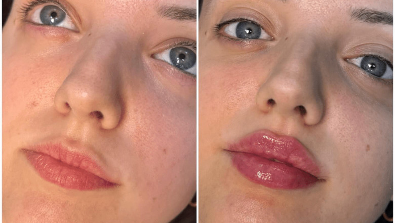 Where to Get the Safest Juvederm Treatments in the Best Aesthetic Clinics in dubai