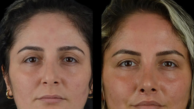 Why the Best Aesthetic Clinics in Dubai Are the Leaders in Safe Cheek Fillers
