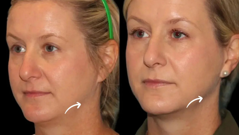 Healthy Lifestyle Habits That Enhance the Results of Sculptra Fillers in Dubai