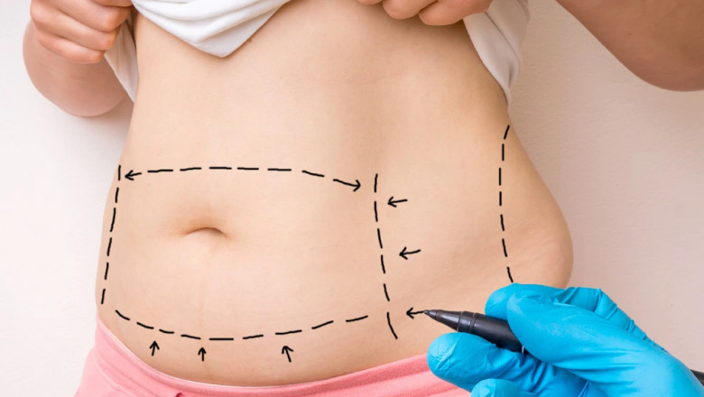 Exploring the Benefits of Fat Transfer: What the Best Doctors in Dubai Recommend