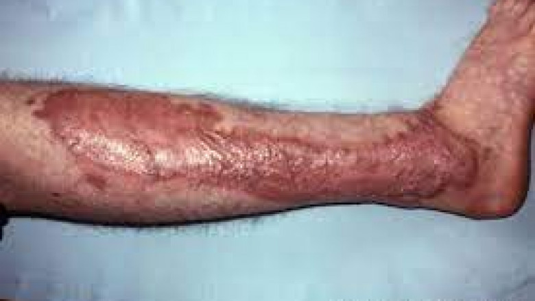Skin Replacement Market Product Innovation and Development Trends to Watch