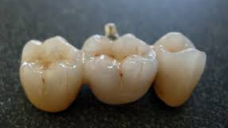 Dental Ceramic Market emerging trends in dental healthcare and cosmetic dentistry