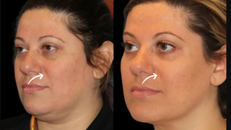 Best Doctors in Dubai Reveal How Sculptra Fillers Improve Skin Texture Over Time
