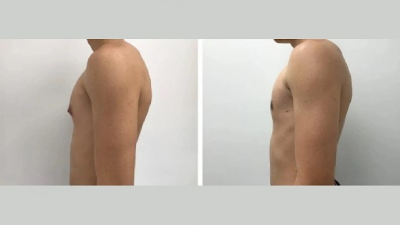 Top Causes of Gynecomastia in Men Living in Dubai