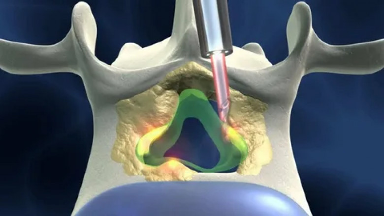 Emerging Technologies in Non-Invasive Back Surgery