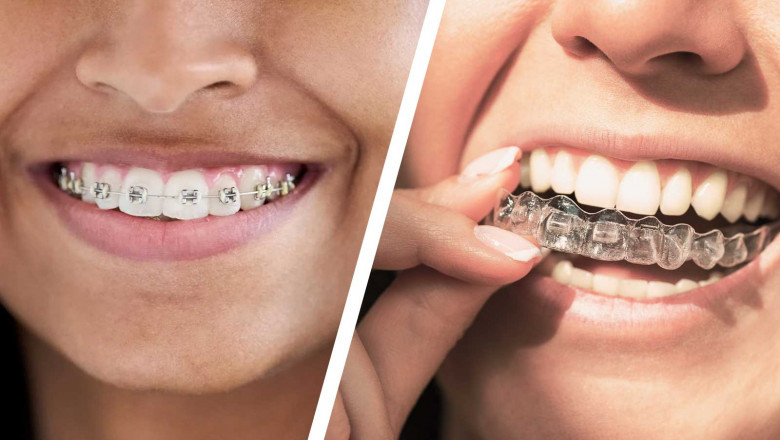 Invisalign vs. Braces: Which Is Right for You? A Markham Dentist’s Take