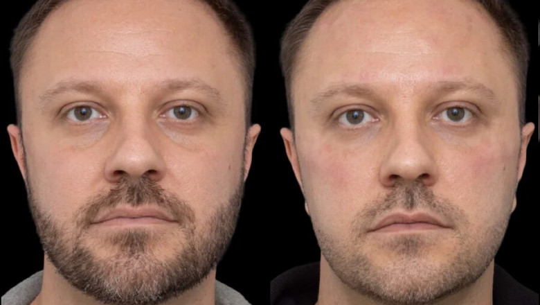 How the Best Clinics for Administer Under Eye Fillers in Dubai Can Enhance Your Look