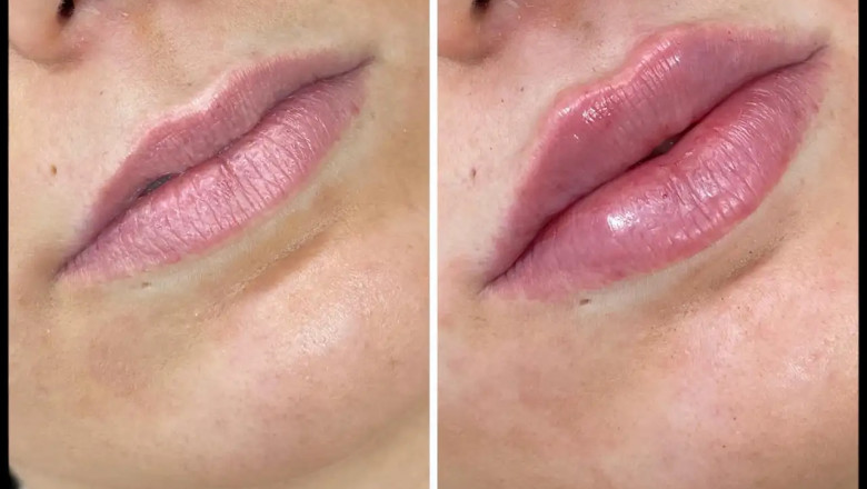 The Best Doctors for Russian Lip Fillers in Dubai and Their Expertise