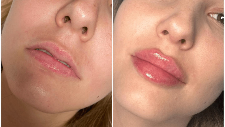 Juvederm for the Neck: Non-Surgical Solutions to Neck Lines, Explained by the Best Plastic Surgeon in Dubai
