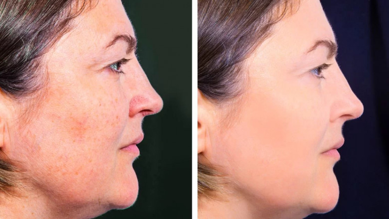 What to Expect During Your Profhilo Treatment at the Best Aesthetic Clinics in Dubai
