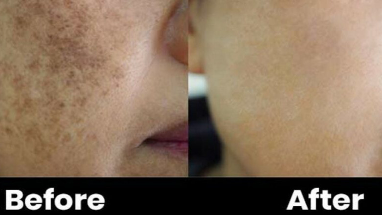 Pigmentation Treatment: Can Pigmentation Return After Treatment