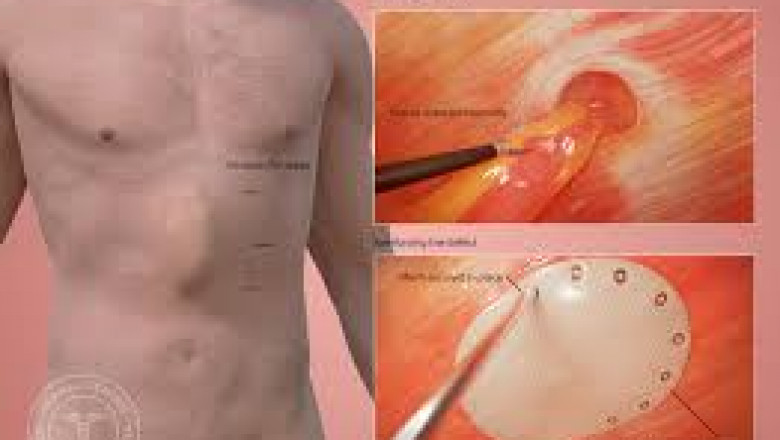 Global Market Forecast: Ventral Hernia Treatment Trends and Opportunities Through 2032