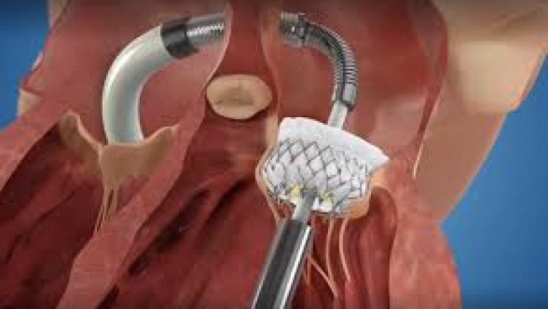 Heart Valve Devices Market Research Highlights Growth, Innovations, and Global Trends