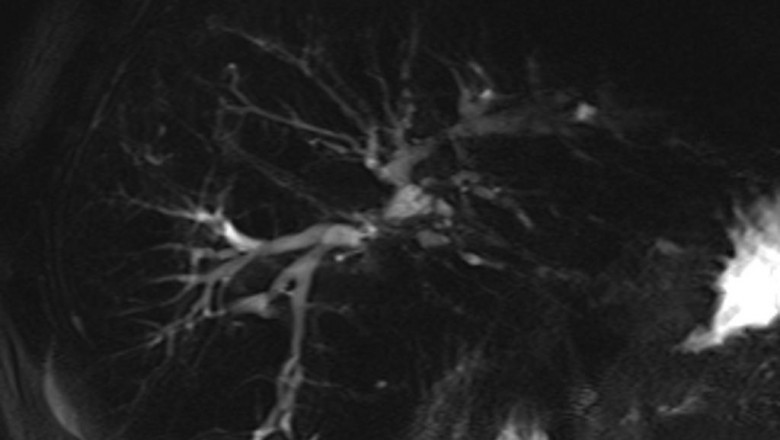 Primary Sclerosing Cholangitis Market Size, Share and Future News by 2025-2033