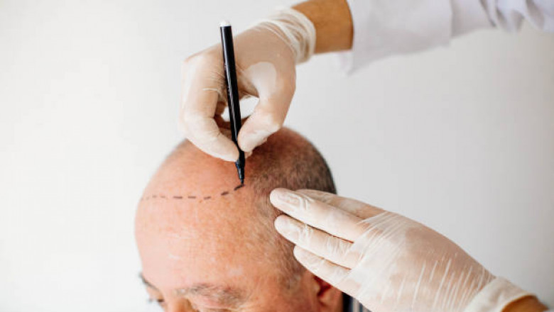 What is the Average Hair Transplant Cost in Dubai?