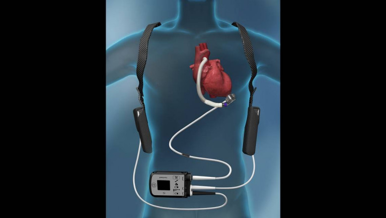 Cardiac Surgery Devices Market Opportunities Flourish Due to Rising Demand for Minimally Invasive Procedures