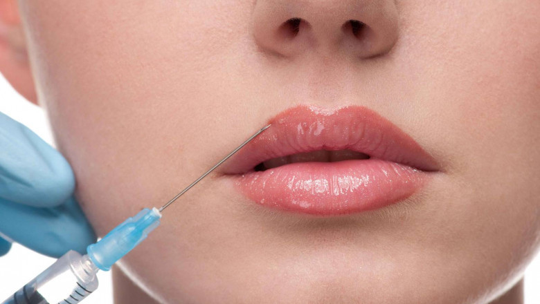 Lip Filler Market Developments Driven by Aesthetic Awareness and Minimally Invasive Treatments