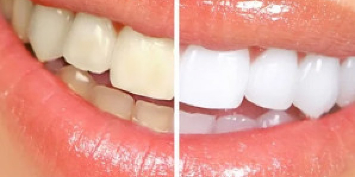 Affordable Teeth Whitening Near You: Everything You Need to Know