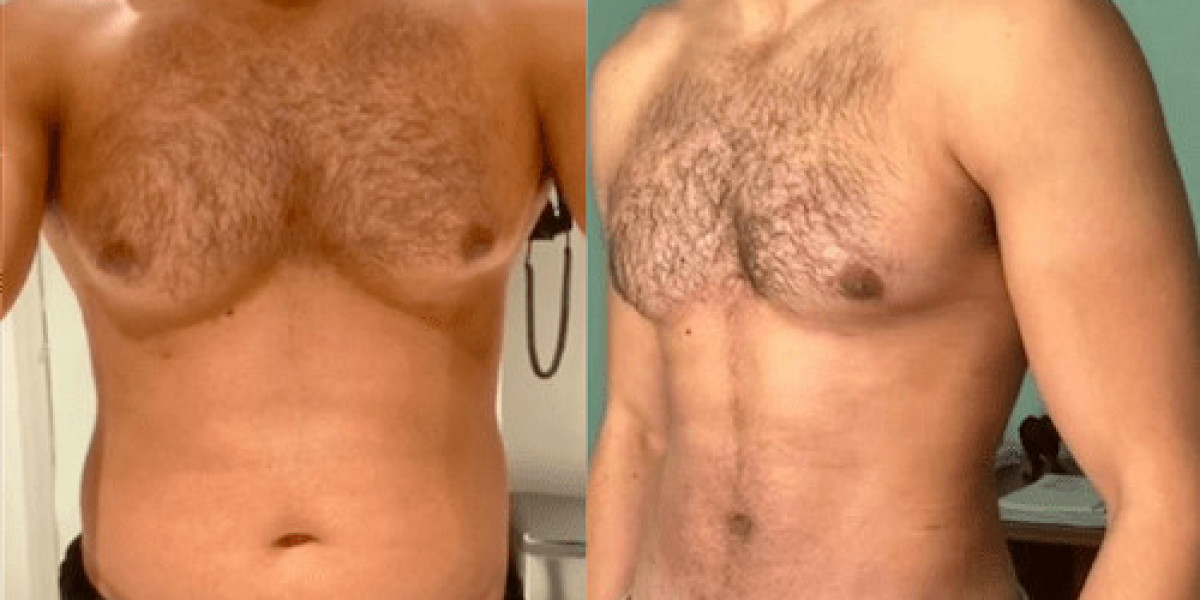 Affordable Options with the Best Gynecomastia Surgeon in Dubai