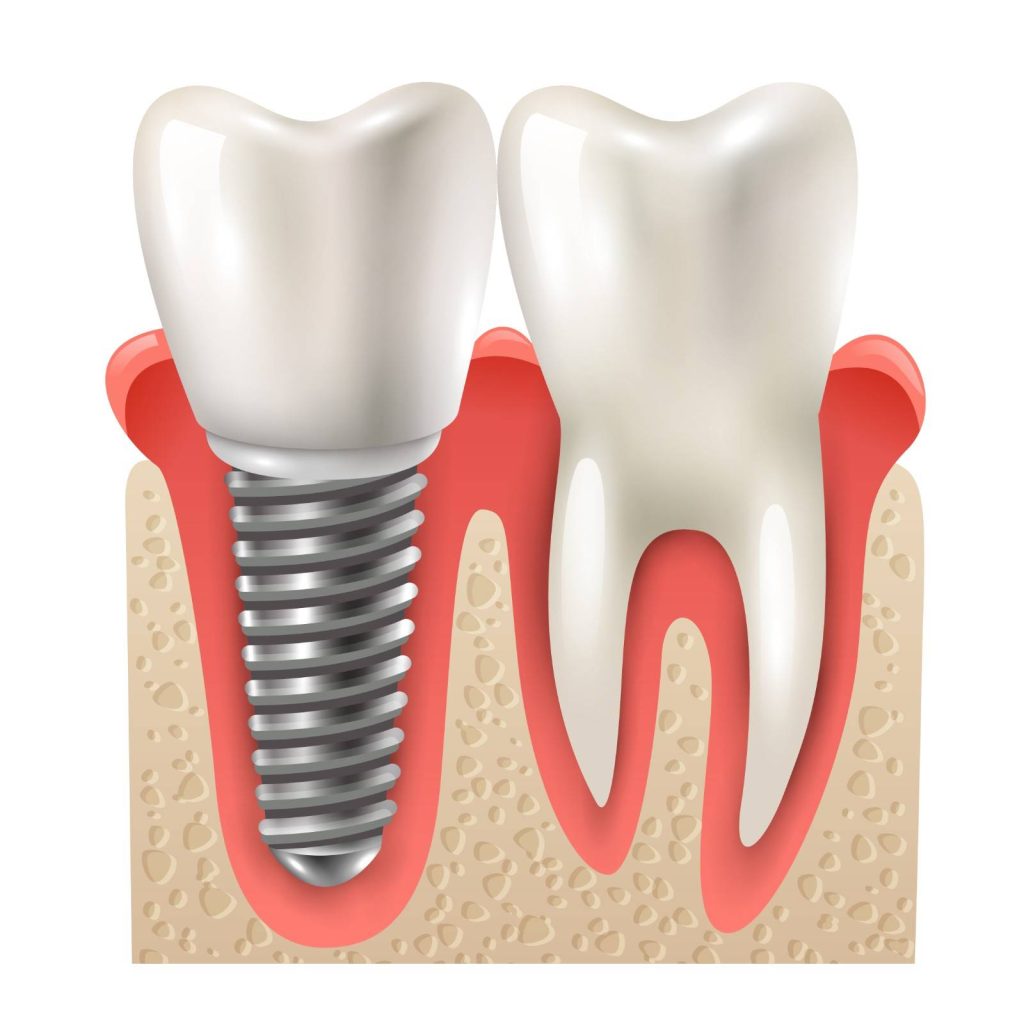 Dental Crown - Hollywood Smile Medical Center