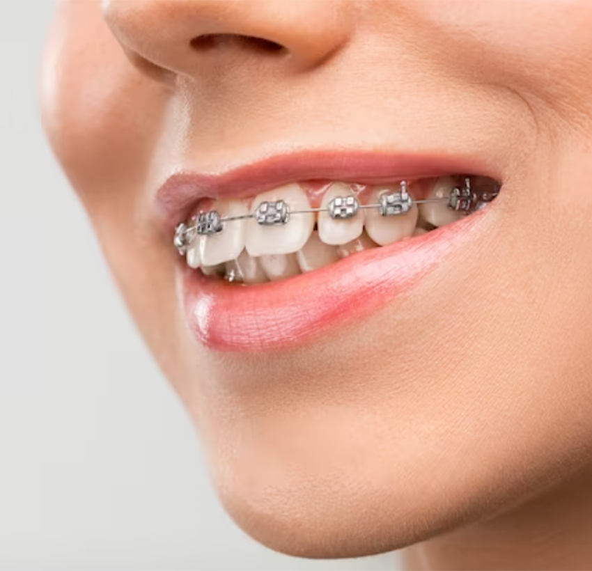 Expert Dental Braces & Regular Braces Adjustment in Al Ain