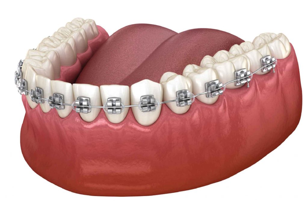 Best Orthodontic Treatment Abu Dhabi | Hollywood Smile