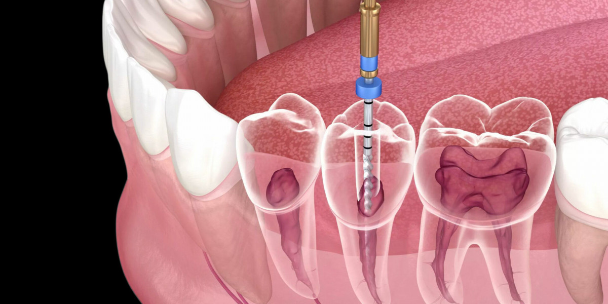 Why You Shouldn’t Delay Root Canal Treatment in Islamabad