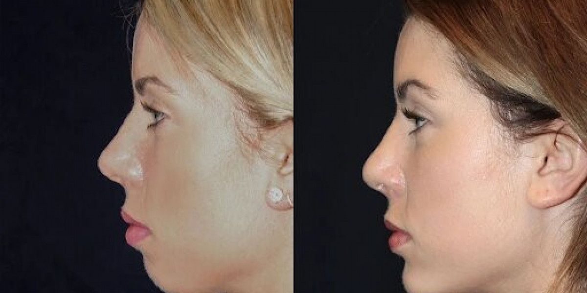 Top Reasons to Choose Chin Fillers at the Best Aesthetic Clinic in dubai