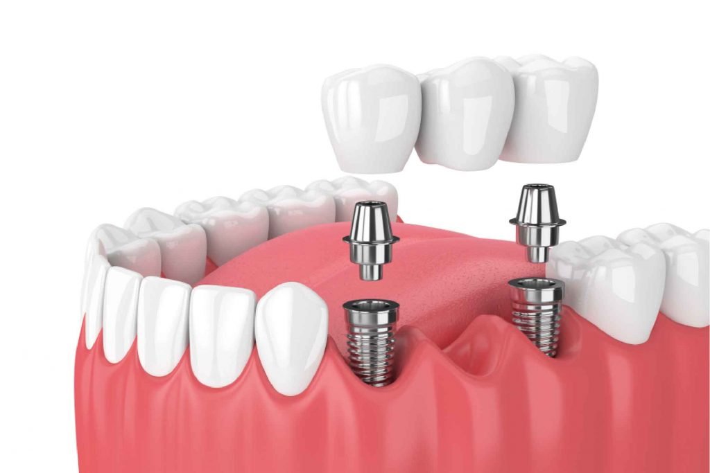 Affordable Dental Implants in Abu Dhabi | Hollywood Smile