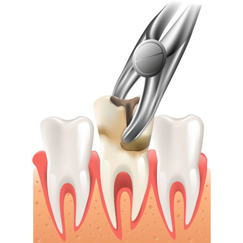 Best Tooth Extraction in Abu Dhabi | Tooth Extraction Abu Dhabi